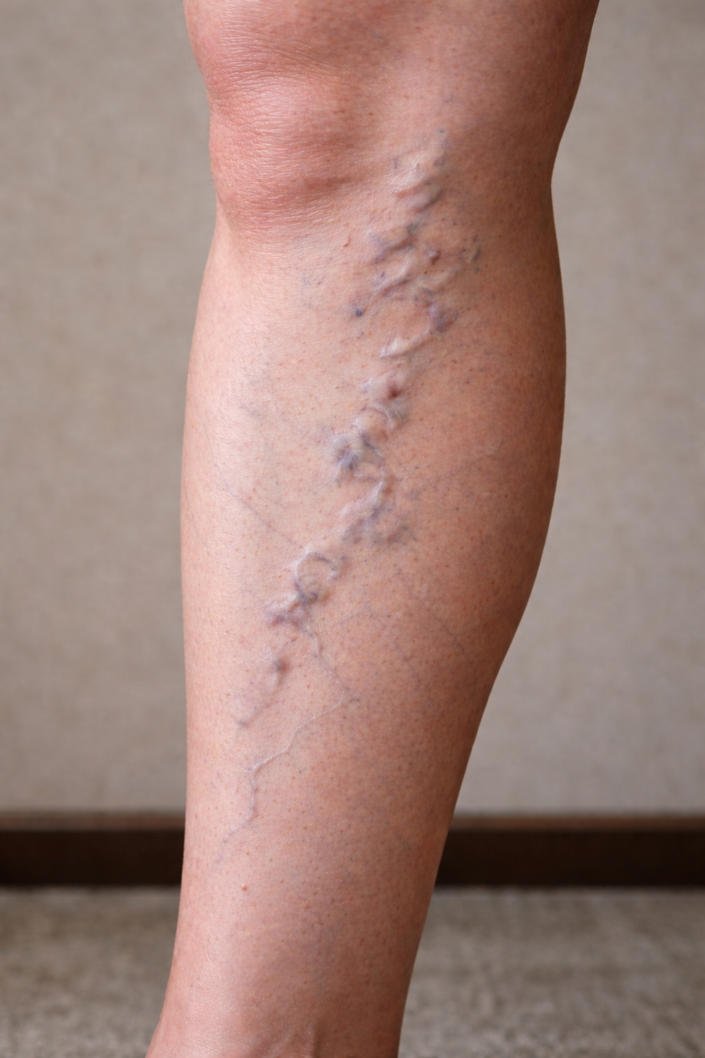 Varicose Veins